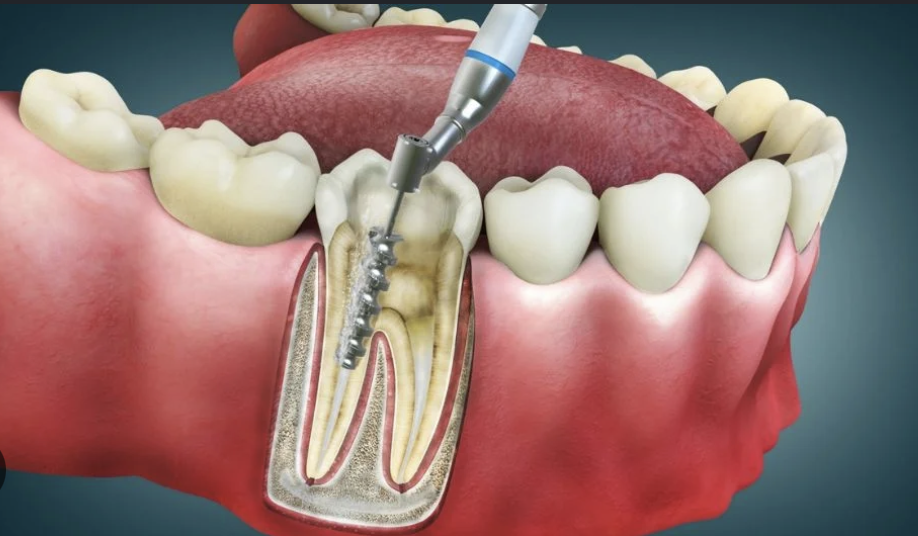 Root canal dental treatment